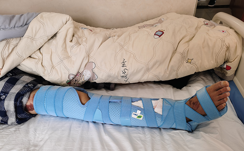 宣威云峰醫(yī)院 脛腓骨固定支具